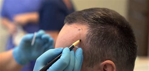 hair transplants st louis|RESTORE Hair .